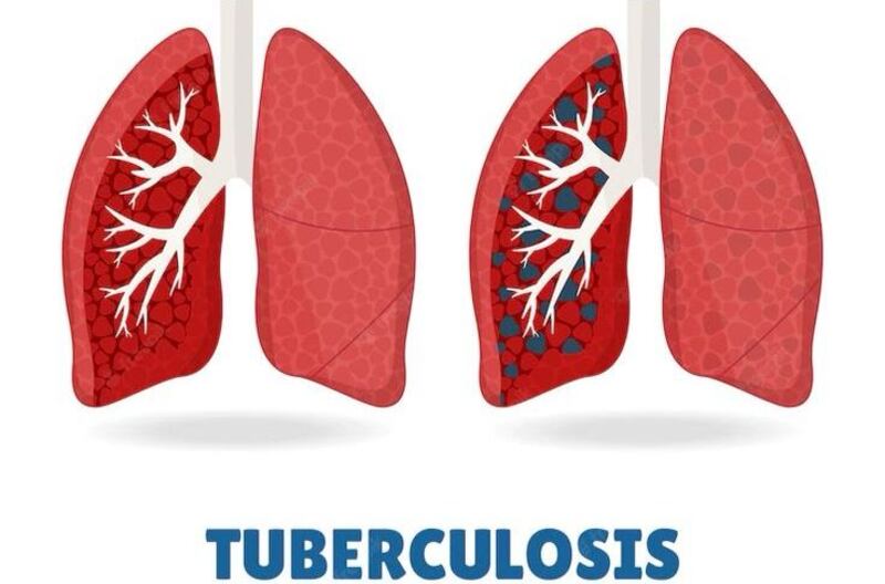 24 de marzo: El día mundial contra la tuberculosis